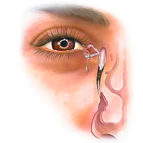 انسداد مجرای اشکی از دلایل احساس وجود جسم خارجی در چشم